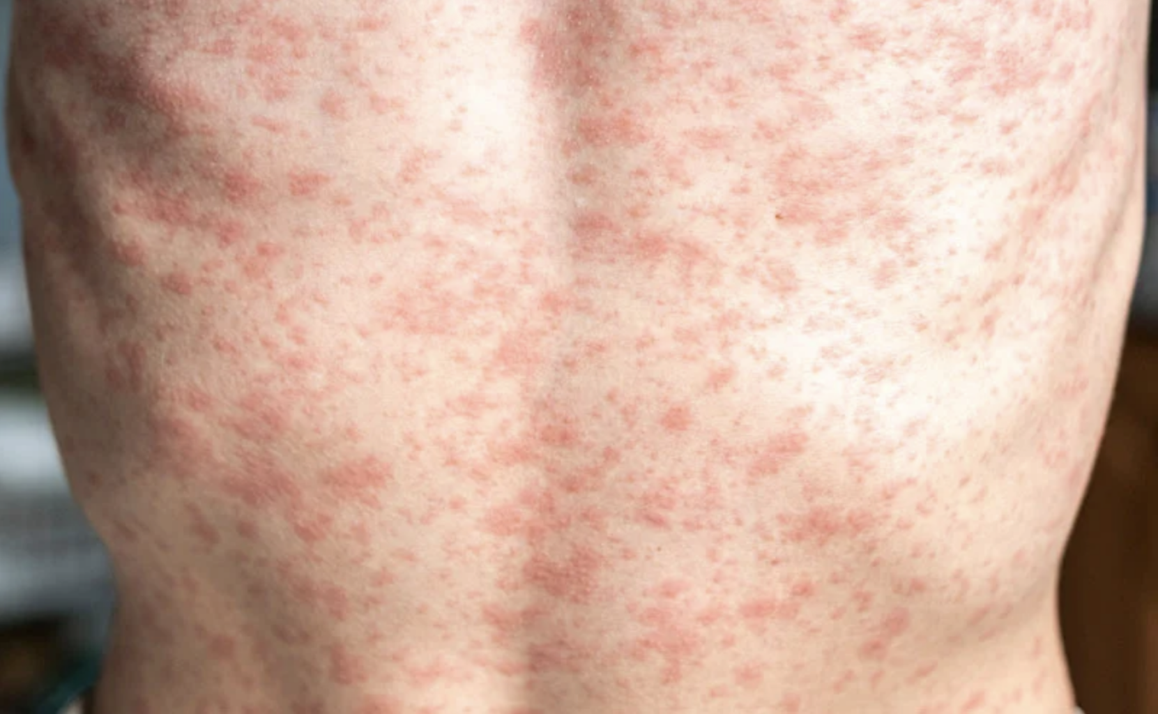 measles